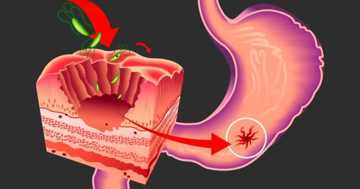 Sintomas de ulcera anal