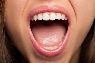 Imagem ilustrativa do artigo Candidíase oral: o que é, sintomas, causas e tratamento