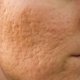 7 formas de quitar las cicatrices de acné del rostro