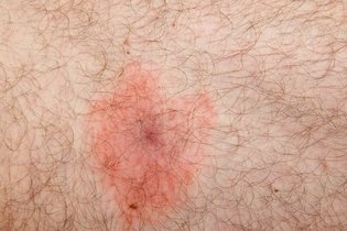 Imagem ilustrativa do artigo Doença de Lyme: o que é, sintomas, causa e tratamento