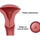 Pólipos endometriales: qué son, causas, síntomas y tratamientos