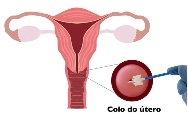 Exame De Papanicolau O Que é Como é Feito E Preparo Tua Saúde 4096