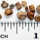 10 sintomas de pedra nos rins (com teste online)