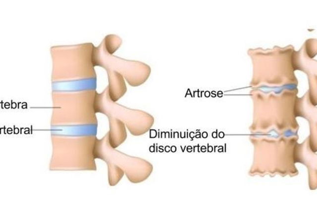 Artrose na coluna