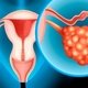 Câncer de ovário: sintomas, exames e tratamento