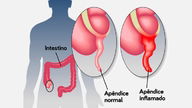 Apendicitis: qué es, síntomas y tratamiento