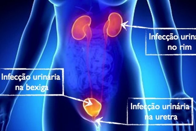 6 sintomas comuns de infecção urinária