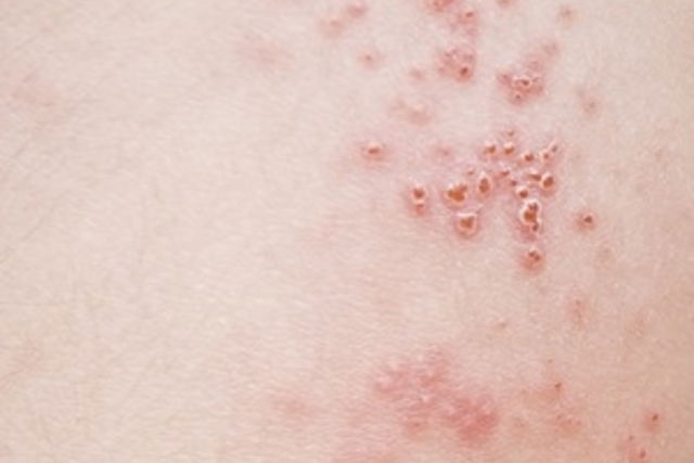 Sintomas De Herpes Genital E Remedios Usados No Tratamento Tua Saude