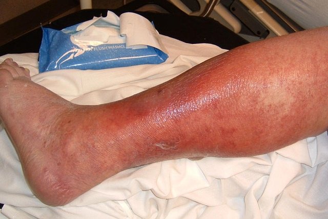 Celulitis infecciosa en la pierna