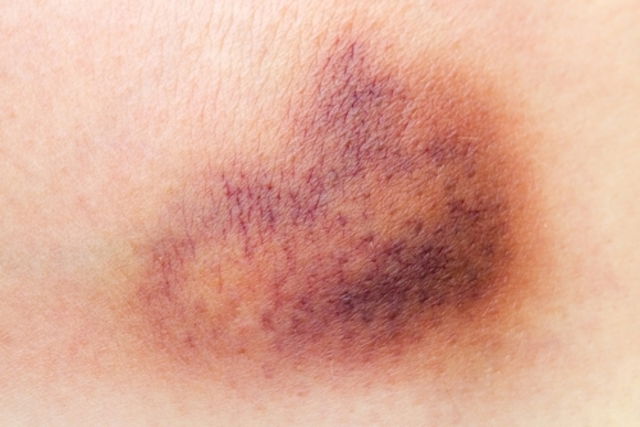 What could cause sudden red, itchy bruise looking spot on breast