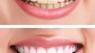 Facetas dentárias de resina ou porcelana: vantagens e desvantagens