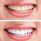 Carillas dentales: qué son, ventajas y desventajas
