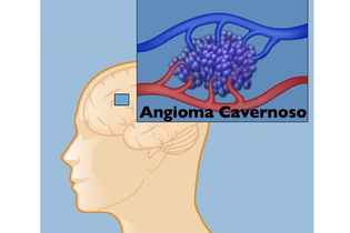 Angioma Cavernoso no cérebro