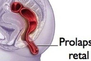 Prolapso rectal: qué es, causas, síntomas y tratamiento