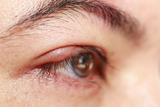 Inflamações palpebrais  Visioclinic Oftalmologia - saiba mais