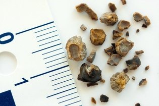 Pedra nos rins: o que é, sintomas, causas e tratamento