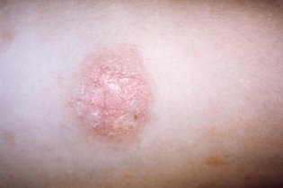 Illustrative image of the article Pityriasis Rosea: Causes, Symptoms, Diagnosis & Treatment