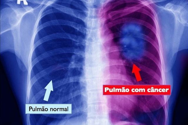 Quase 20% dos pacientes com câncer de pulmão continuam fumando