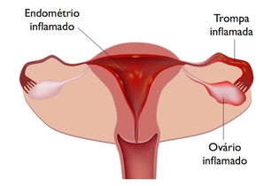 Doença inflamatória pélvica (DIP)