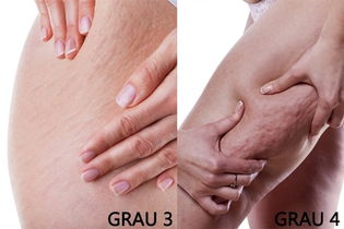 Como eliminar a Celulite das Pernas, Bumbum e Coxas Como eliminar a Celulite das Pernas, Bumbum e Coxas