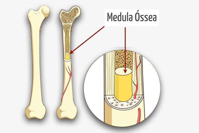 Garota de 10 anos precisa de doador de Medula óssea