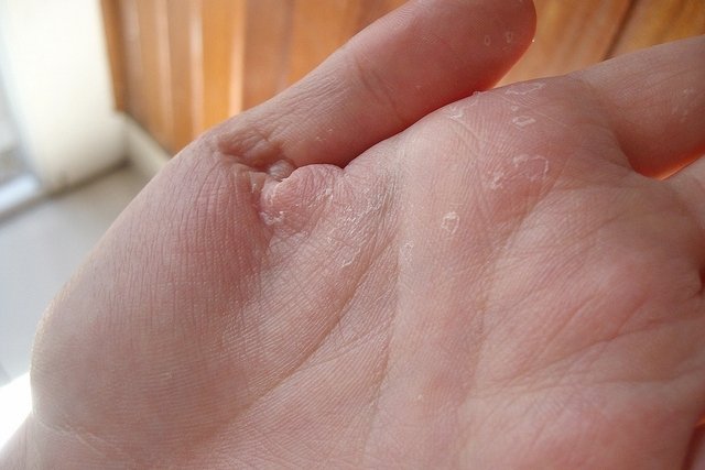 Dermatitis en manos: síntomas, causas y tratamiento - Tua Saúde