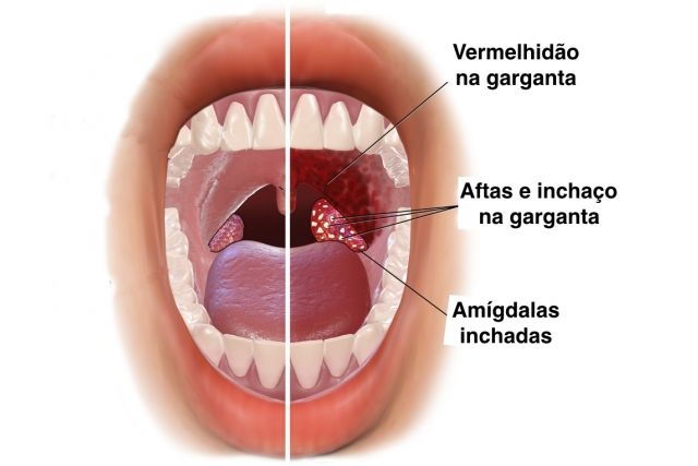 Como curar a garganta inflamada