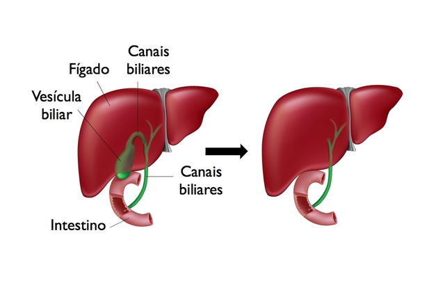 Quem fez cirurgia de vesícula pode se abaixar? Confira aqui!