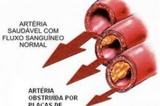 Sintomas da aterosclerose Tua Saúde