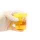 Nitrito positivo na urina: o que significa e como é feito o exame