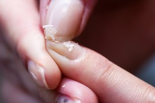 Illustrative image of the article Brittle Nails: 6 Common Causes & What To Do