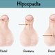 Hipospádia: o que é, tipos, sintomas e tratamento