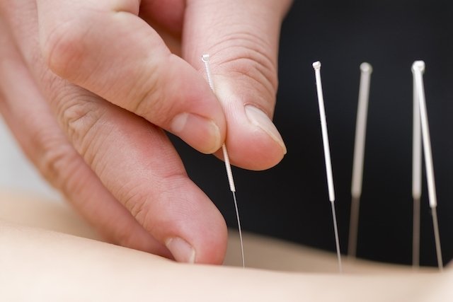 Processo de colocação das agulhas de acupuntura
