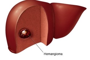 Hemangioma no fígado (hepático): o que é, sintomas e tratamento
