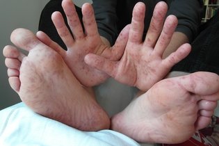 Enfermedad de manos, pies y boca: síntomas y tratamiento