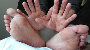 Doença mão-pé-boca: sintomas, transmissão e tratamento