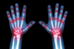 Imagem ilustrativa do artigo Artrite reativa: o que é, tratamento, sintomas e causas