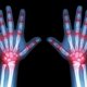 Artrite reativa: o que é, tratamento, sintomas e causas