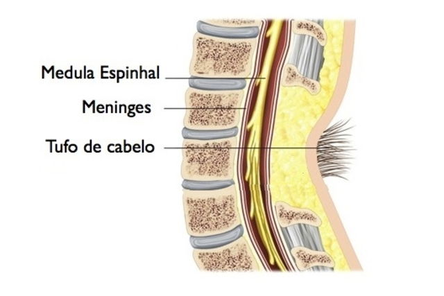 espinha bífida covinha sacral