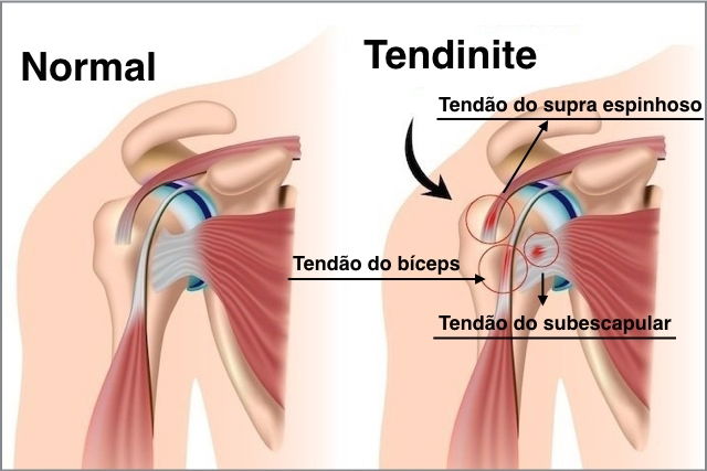 Tratamento para Tendinite no Ombro