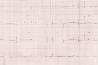 Imagen ilustrativa del artículo Electrocardiograma (ECG): qué es, cómo leerlo y para qué sirve