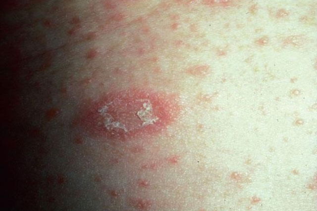 Christmas Tree Rash: Symptoms, Causes & Treatment