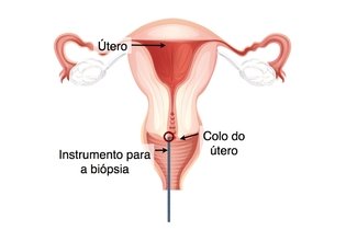 Imagem ilustrativa do artigo Saiba quais são os exames do colo do útero