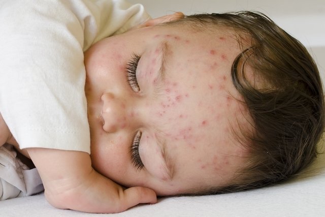 Problemas de pele comuns no bebê Causas e Tratamentos