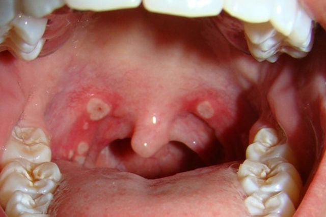 aphthous ulcers throat