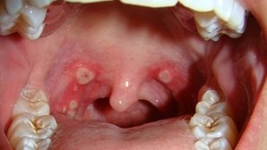 Throat Ulcers: Causes & Treatment Options