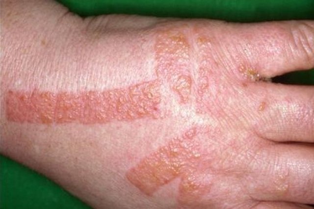 Dermatitis en las manos: causas y tratamiento - Tua Saúde