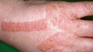 Dermatitis en las manos: síntomas, causas y tratamiento 