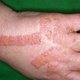 Dermatitis en las manos: síntomas, causas y tratamiento 