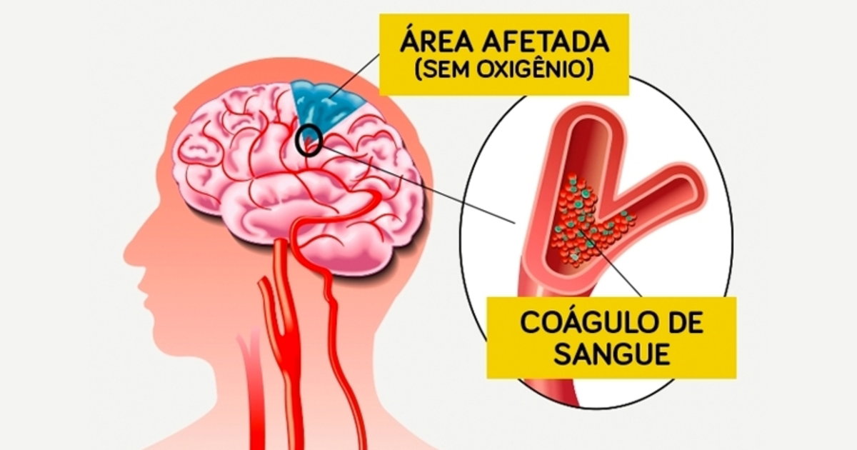 trombose cerebral sintomas causas e tratamento tua saúde